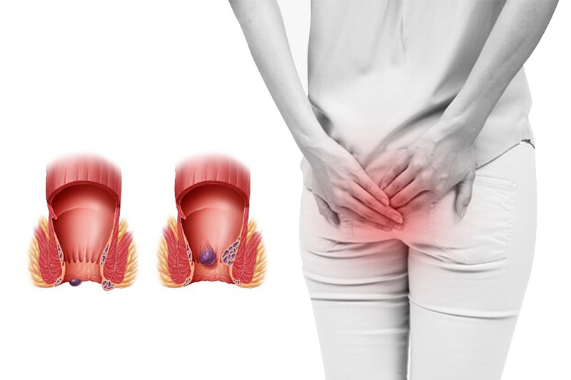 Cần lưu ý gì trước khi quyết định điều trị trĩ bằng laser tại Quy Nhơn?